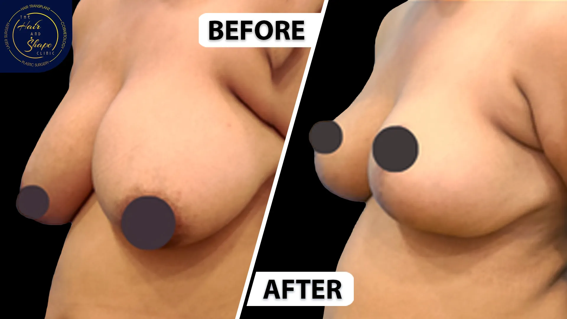Breast Reduction result